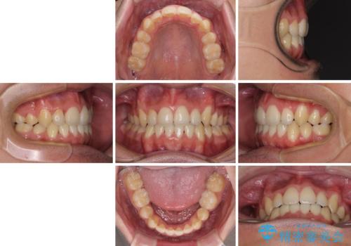八重歯を治したい 目立たないワイヤー装置での抜歯矯正の治療後