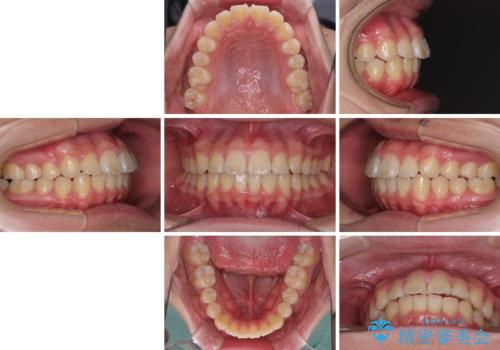 前歯のデコボコを短期間で治療 目立たないワイヤー矯正の治療後