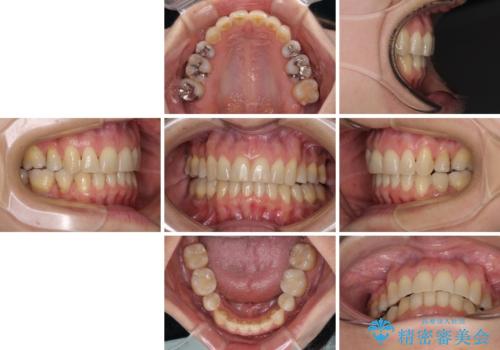 矯正の後戻りの改善と銀歯をセラミックにの治療後