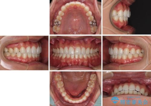 気になる後戻り 前歯をインビザライン・ライトで改善の治療後