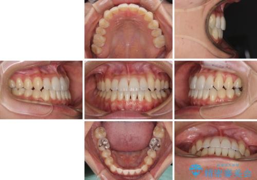 前歯のデコボコ インビザラインによる矯正治療の治療後