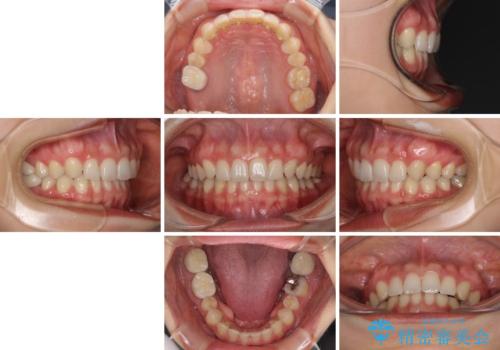 隙間だらけの歯列をきれいに インビザライン矯正とセラミック補綴治療の治療後