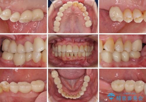 歯周病改善のための総合歯科治療