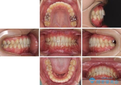 海外勤務中のインビザラインによる矯正治療の治療後