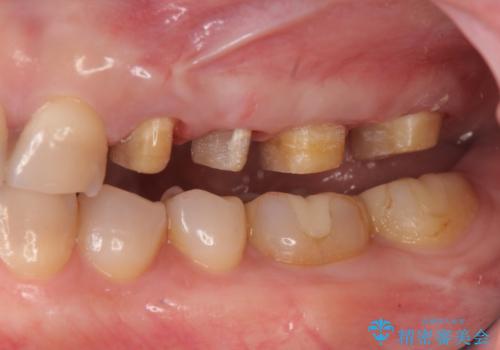 放置した虫歯 根管治療 フルジルコニアクラウンの治療中