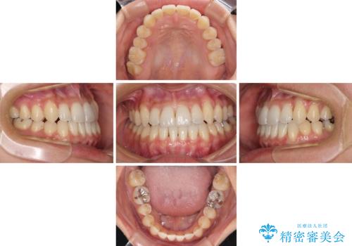 前歯のデコボコ インビザラインによる矯正治療の治療中