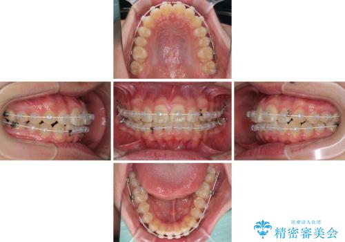 前歯のデコボコを短期間で治療 目立たないワイヤー矯正の治療中
