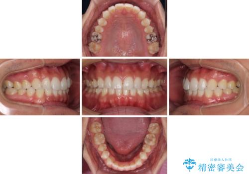 気になる後戻り 前歯をインビザライン・ライトで改善の治療中
