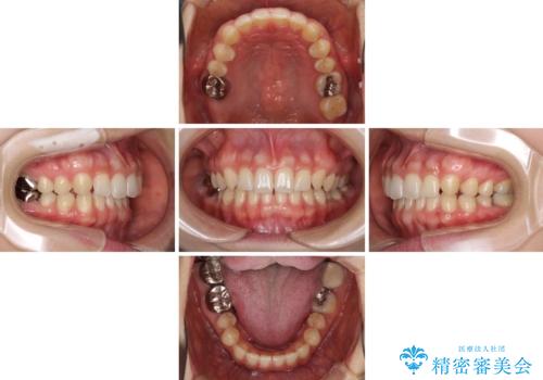 隙間だらけの歯列をきれいに インビザライン矯正とセラミック補綴治療の治療中