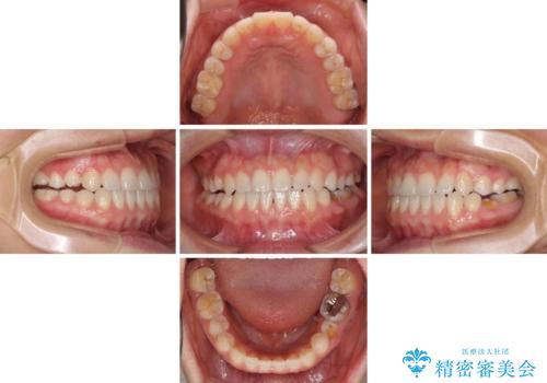 隙間の空いた前歯を治したい インビザライン矯正治療の治療中