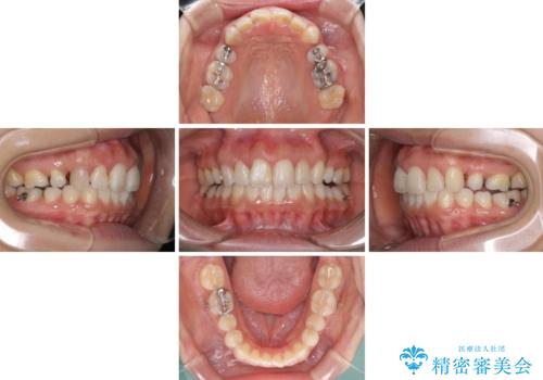 前歯の突出を軽減 インビザラインによる抜歯矯正の治療中