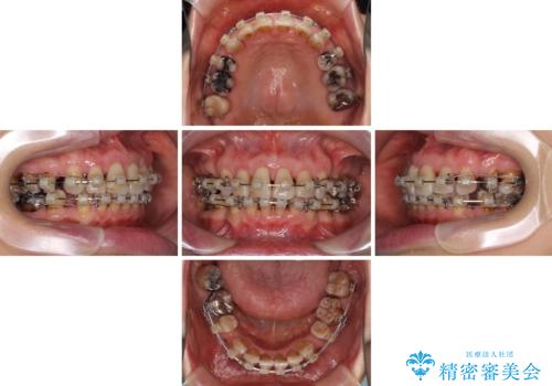 閉じにくい口元を改善したい ワイヤー装置での抜歯矯正の治療中