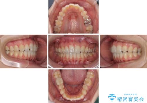 気になる上の歯を改善 インビザライン矯正の治療中
