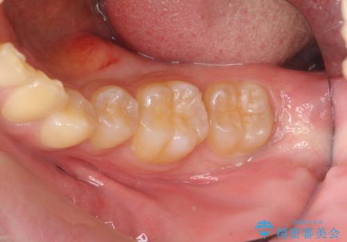 [骨隆起除去手術 ]  舌のスペースを確保するの症例 治療前