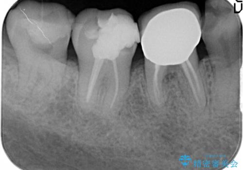 虫歯の治療　オールセラミッククラウンの治療前