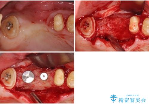 歯周病改善のための総合歯科治療の治療中