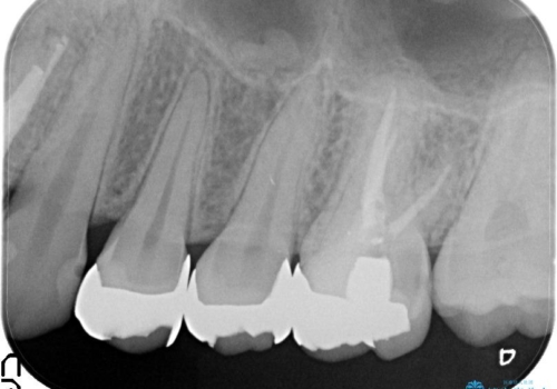見える金属を白くしたい、セラミック治療の治療前