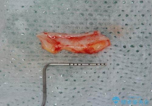 歯磨きすると歯がしみる 結合組織移植による根面被覆の治療中