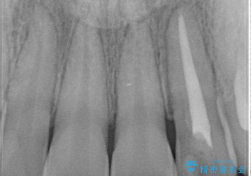 前歯の変色 オールセラミッククラウンの治療前