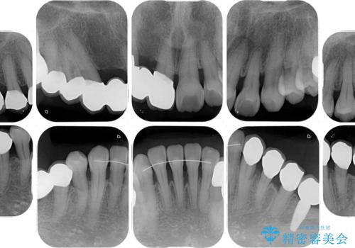 歯周病改善のための総合歯科治療の治療後