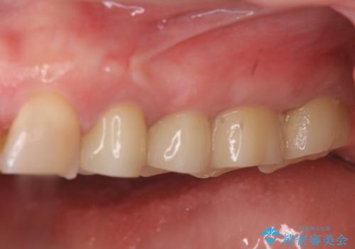 放置した虫歯 根管治療 フルジルコニアクラウンの治療後