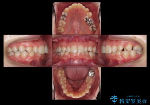 前歯を整えたい 小さい前歯がある 矯正・セラミック併用で美しく インビザラインでも抜歯矯正できますの治療前