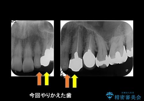 前歯が左右対称じゃない　保険の被せ物をきれいにしたい　ホワイトニング併用の治療前