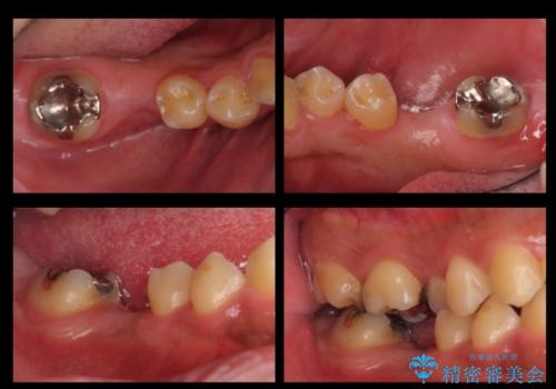 初めてのインプラント 手術は怖いので、寝ている間に終わりたいの治療前