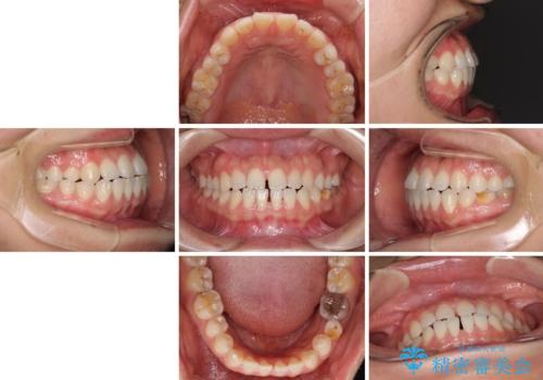 隙間の空いた前歯を治したい インビザライン矯正治療の治療前