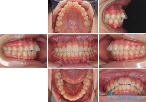 前歯のデコボコを短期間で治療 目立たないワイヤー矯正の治療前