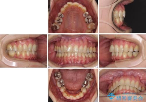 矯正の後戻りの改善と銀歯をセラミックにの治療前