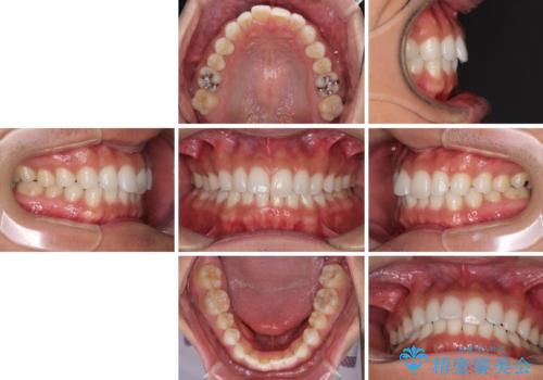 気になる後戻り 前歯をインビザライン・ライトで改善の治療前