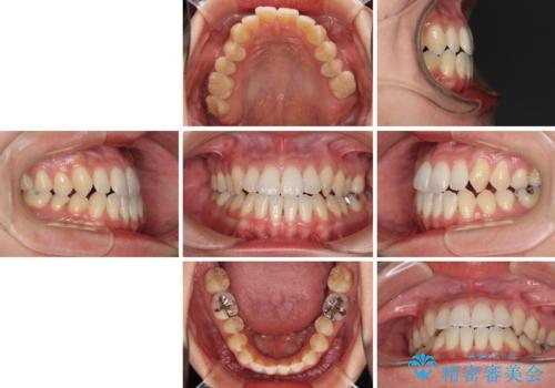 前歯のデコボコ インビザラインによる矯正治療の治療前