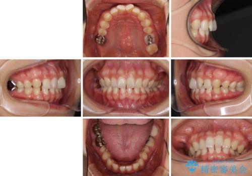 隙間だらけの歯列をきれいに インビザライン矯正とセラミック補綴治療の治療前
