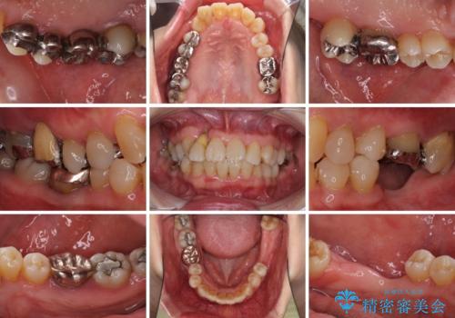歯周病改善のための総合歯科治療の治療前