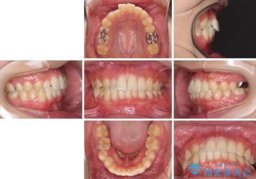 海外勤務中のインビザラインによる矯正治療の治療前
