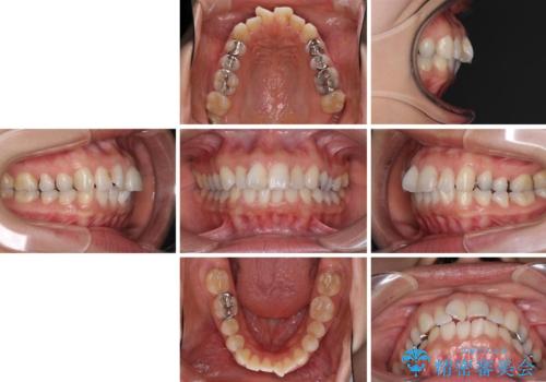 前歯の突出を軽減 インビザラインによる抜歯矯正の治療前