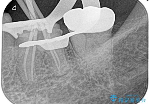 奥歯がズキズキ痛い 根管治療の治療中