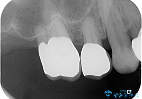 歯周病の進行した歯の抜歯。オールセラミッククラウンの治療後