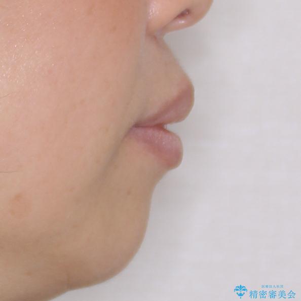 閉じにくい口元を改善したい ワイヤー装置での抜歯矯正の治療前(顔貌)