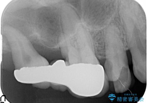歯周病の進行した歯の抜歯。オールセラミッククラウンの治療前