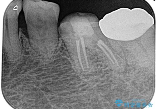 奥歯がズキズキ痛い 根管治療の治療後