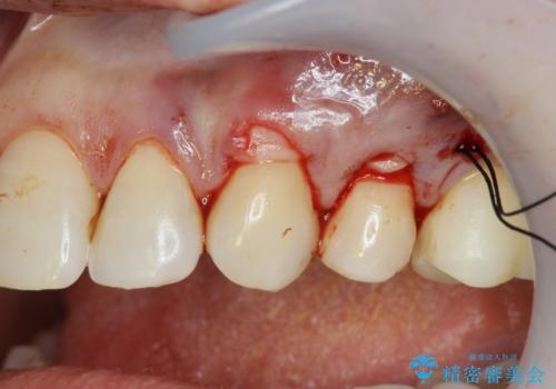 歯磨きすると歯がしみる 結合組織移植による根面被覆の治療中