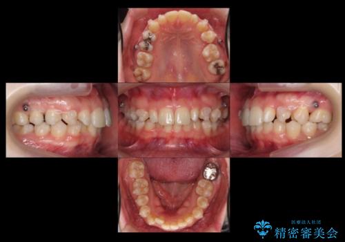 前歯を整えたい 小さい前歯がある 矯正・セラミック併用で美しく インビザラインでも抜歯矯正できますの治療中