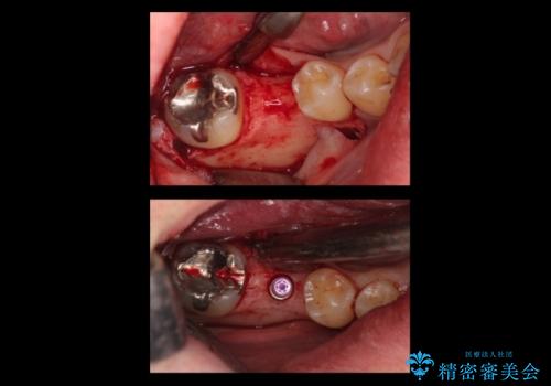 初めてのインプラント 手術は怖いので、寝ている間に終わりたいの治療中