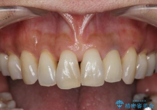 [歯の変色]  根管治療　セラミッククラウンの製作の治療後