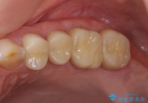 放置した虫歯　根管治療　フルジルコニアクラウンの症例 治療後