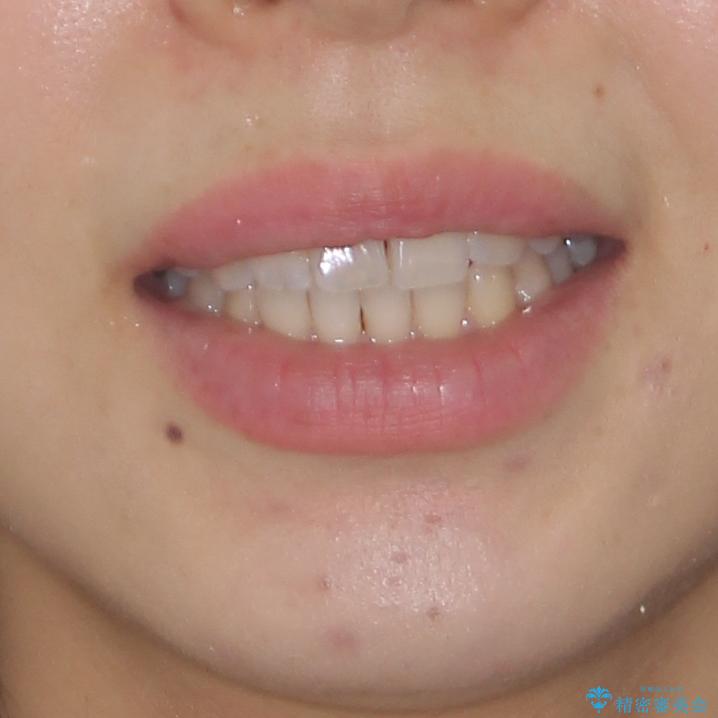 気になる上の歯を改善　インビザライン矯正の治療後（顔貌）