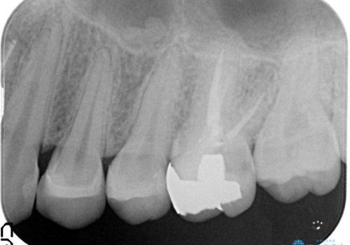 見える金属を白くしたい、セラミック治療の治療後