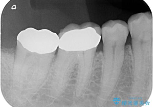 虫歯の治療 ゴールドクラウンの治療後